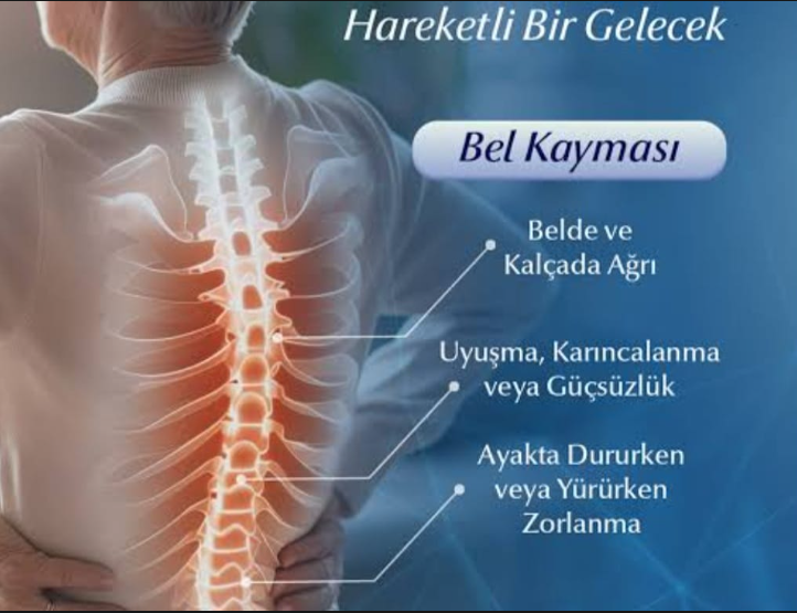 Bel kayması belirtileri: belde ve kalçada ağrı, uyuşma, karıncalanma